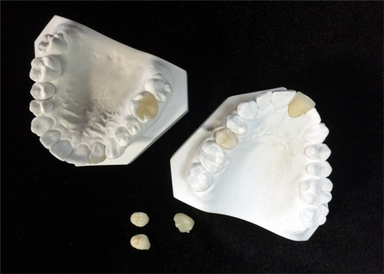 Fácil mantenha o Onlay dental cerâmico branco do embutimento do folheado da coroa do OEM