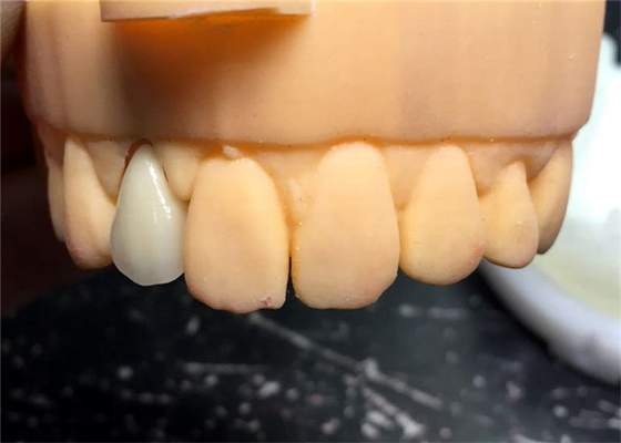 Ponte dental bom Biocompatibility da coroa da segurança PFM de Chromecast