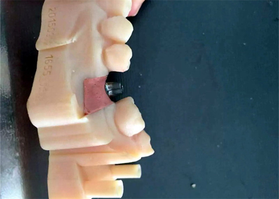 CAD / CAM PFM Coroas Dentárias Ponte Resina Material Boa Biocompatibilidade Estabilidade