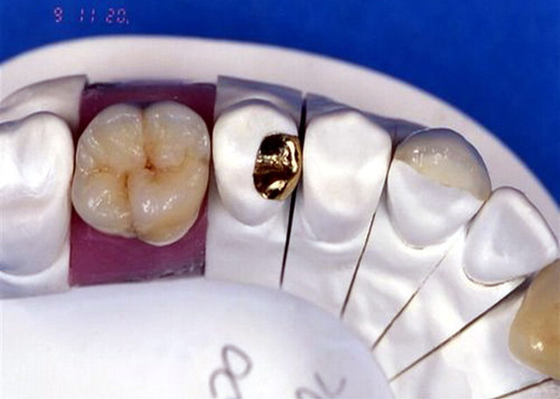 Coroa dental da porcelana de PFM