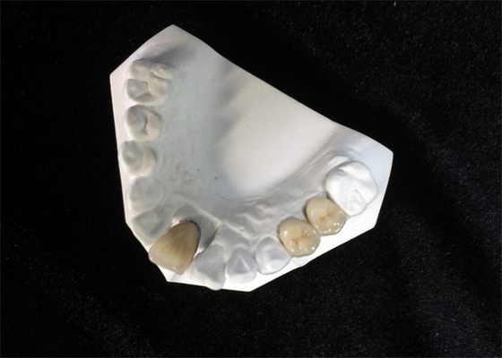 O dente natural da coroa dental cerâmica alta da estabilidade PFM mancha resistente