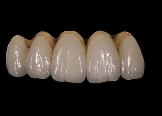 Fácil mantenha a estabilidade de cor dental da coroa da porcelana ortodôntica de PFM