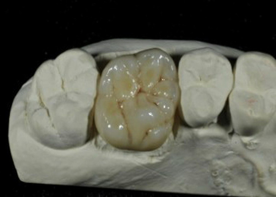 Coroa dental da porcelana flexível do ISO do CE para a restauração dos dentes traseiros
