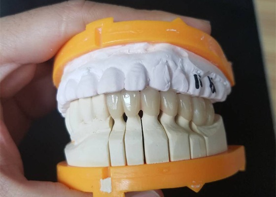 Coroas cerâmicas feitas sob encomenda do tamanho PFM para os dentes traseiros e anteriores