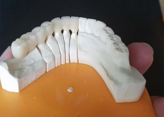 Coroas cerâmicas feitas sob encomenda do tamanho PFM para os dentes traseiros e anteriores