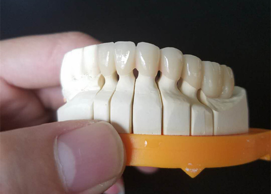 Coroas cerâmicas feitas sob encomenda do tamanho PFM para os dentes traseiros e anteriores