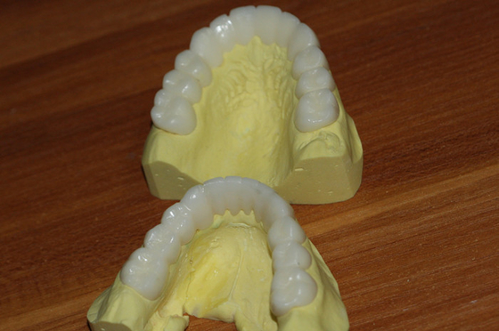 Coroa dental provisória de PFM