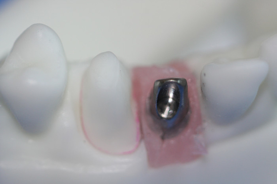 Limite feito sob encomenda da barra pura removível do implante dental do titânio