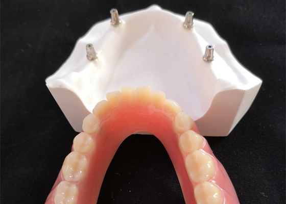 O implante dental confortável Overdenture do CAD CAM fácil mantém