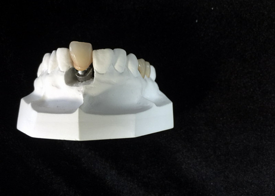 Dentadura alta do acessório de barra da estabilidade dos localizadores feitos sob encomenda do implante dental