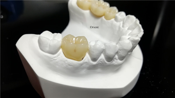 Coroas Dentárias de Cerâmica, Coroas Dentárias de Zirconia