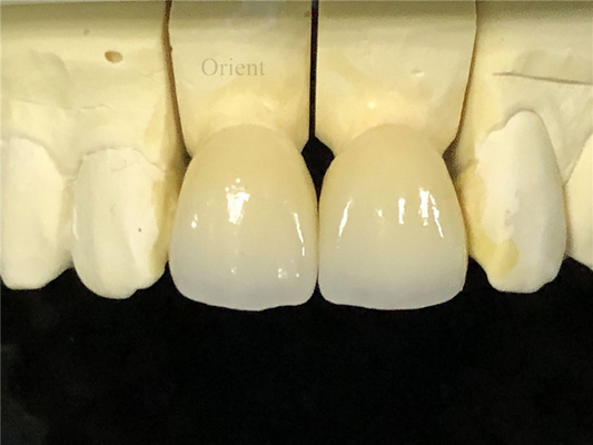Coroas Dentárias de Cerâmica, Coroas Dentárias de Zirconia