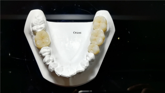 Coroas Dentárias de Cerâmica, Coroas Dentárias de Zirconia
