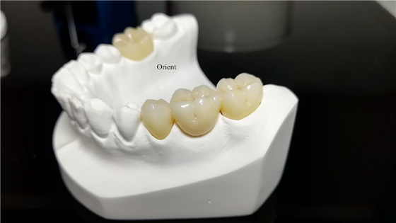 Coroas Dentárias de Cerâmica, Coroas Dentárias de Zirconia