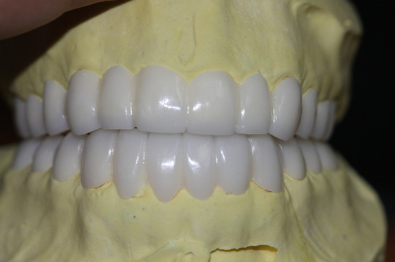Coroa dental provisória de PFM