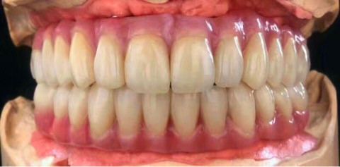 Coroas e pontes de dentes totalmente cerâmicas de zircônio