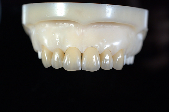 Laboratório Dental de Dentadura de Zirconia Personalizado - Entrega e Reparação Rápida