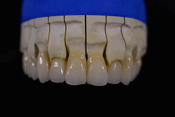 Laboratório de Fabricação de Prótese Obtendo Prótese Perfeitamente Branca com Reparação de Zirconia
