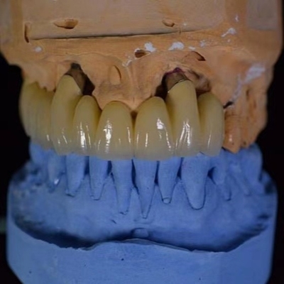 A porcelana da coroa de FDA PFM fundiu à coroa do metal