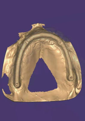 3D model Zirconia crown