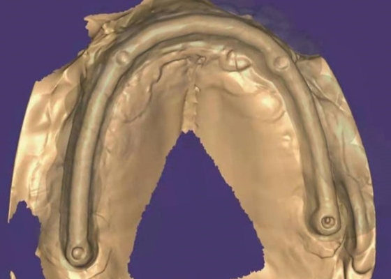 Coroa dental de zircônio: Dentes de aparência natural, duráveis e seguros
