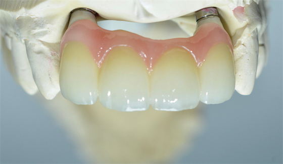 O si forte baseia o implante dental de trituração coroa a ponte apoiada dente