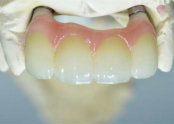 O si forte baseia o implante dental de trituração coroa a ponte apoiada dente