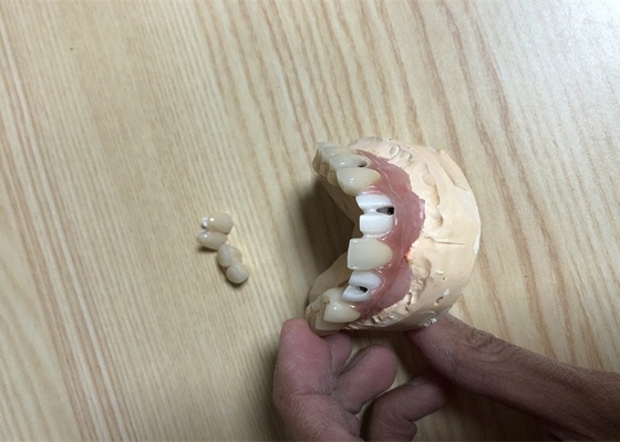 Coroa exata do implante do dente dos acessórios do implante dental de Biocompatibility
