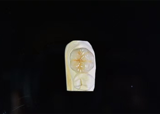 Super resistência coroa dental de porcelana alta intermiscibilidade biológica