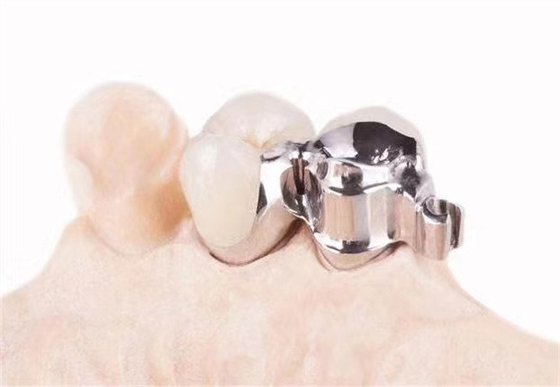 Acessórios de precisão personalizados para clínicas dentárias