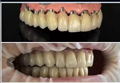 Implantes dentários Telescópio PFM ponte de porcelana