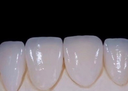 EMAX Durabilidade Finetes dentárias compostas CAD/CAM Altamente detalhadas Exactas