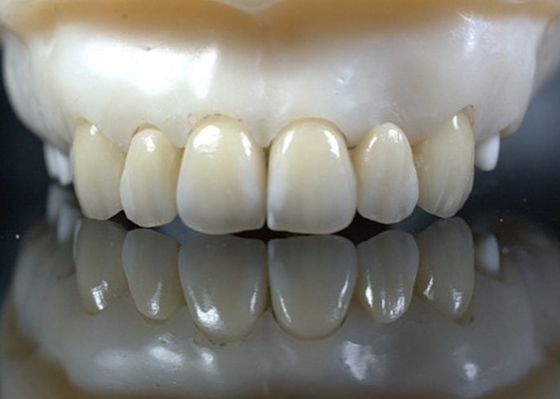 EMAX Durabilidade Finetes dentárias compostas CAD/CAM Altamente detalhadas Exactas