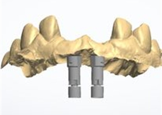 Design CAD/CAM preciso de coroa dental de zircônio para ajuste