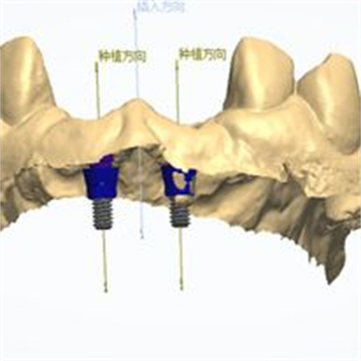 Design CAD/CAM preciso de coroa dental de zircônio para ajuste