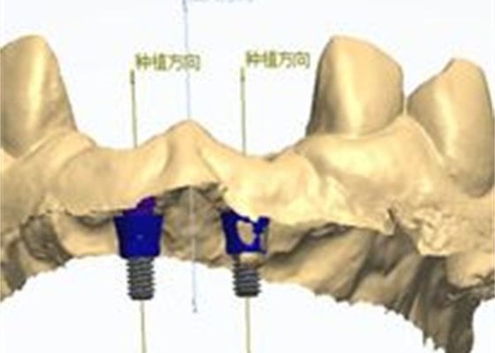 Modelo 3D Coroa de zircônio