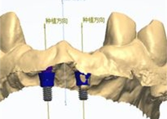 Design CAD/CAM preciso de coroa dental de zircônio para ajuste