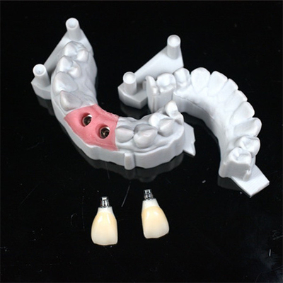 Design CAD/CAM preciso de coroa dental de zircônio para ajuste