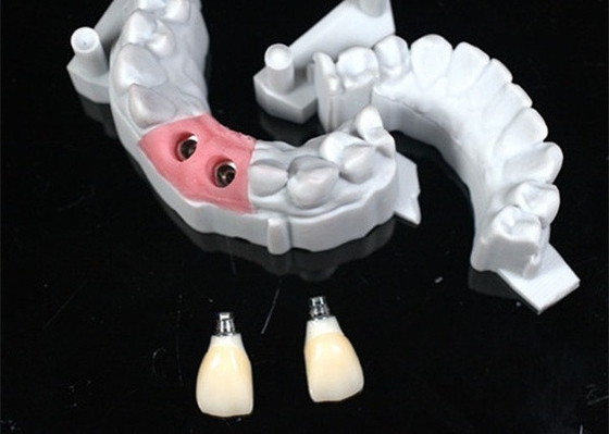 Design CAD/CAM preciso de coroa dental de zircônio para ajuste