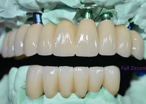 OEM Implante de zircônio ponte fixa de coroa dentária