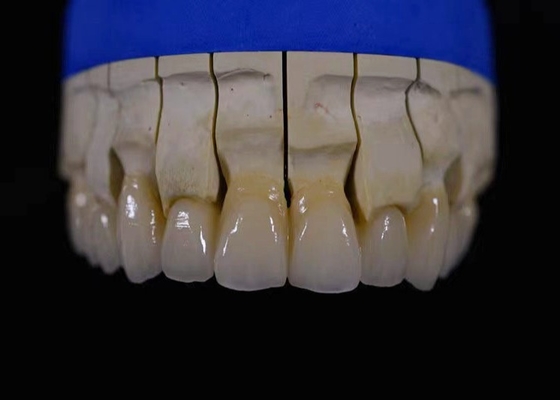 A zircônia dental da restauração da coroa da zircônia completa da boca fixou a resistência química da ponte