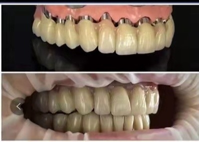 A coroa telescópica 3D dental da ponte da coroa do implante do CAD CAM PFM imprimiu modelos