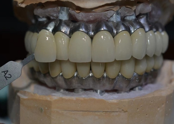 Satisfação paciente da prioridade nosso compromisso às coroas do implante dental da qualidade