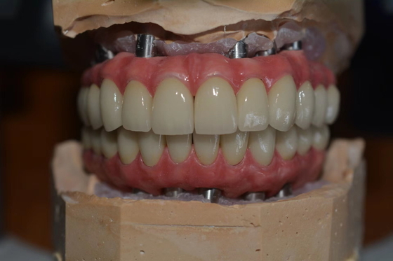Coroas de implantes dentários de fabricação precisa para conforto e confiança