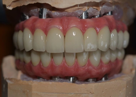 Satisfação paciente da prioridade nosso compromisso às coroas do implante dental da qualidade