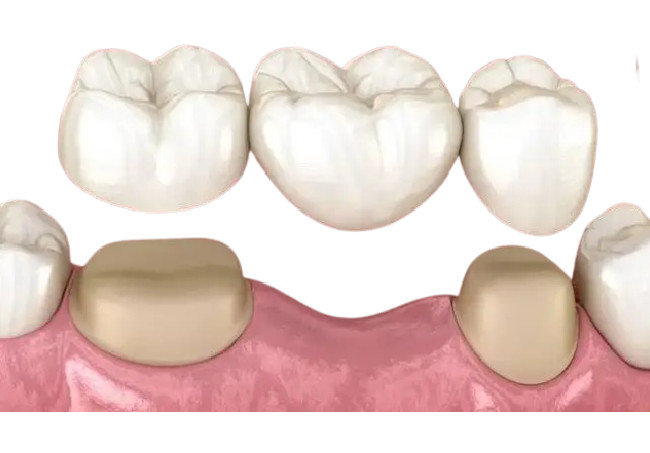 A resina 3D imprimiu as cores naturais da ponte provisória da coroa resistentes à corrosão