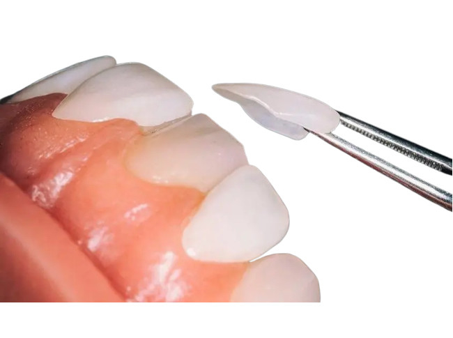 Desgaste dental feito sob encomenda da empresa do folheado da porcelana do OEM - resistente para a restauração dental