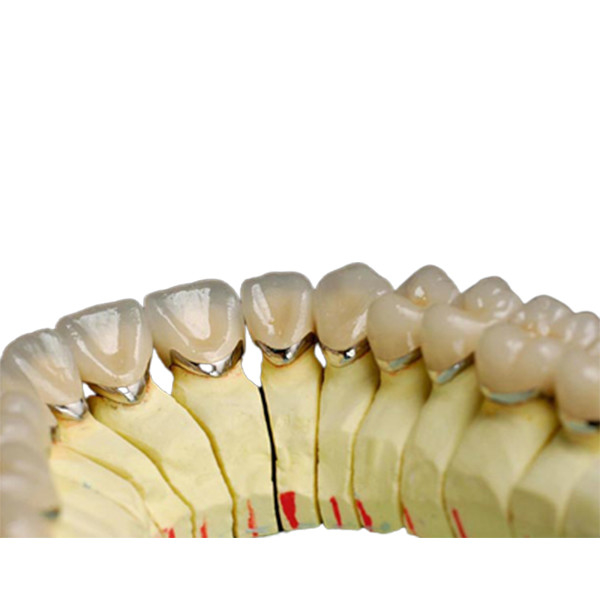 Dente natural da porcelana do metal da coroa dental dental da porcelana da liga do titânio do laboratório
