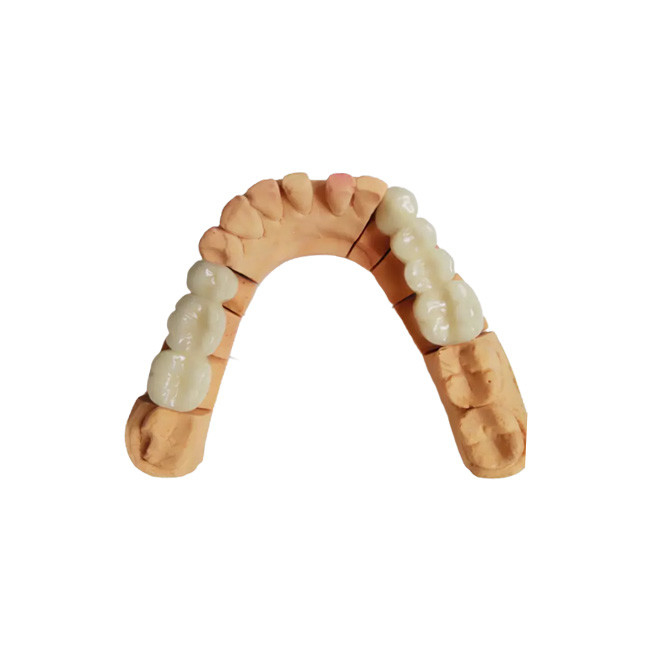 Cor estável PFM Dental Coroa resistente a ácidos e álcalis não é fácil de usar