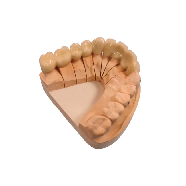 Superfície lisa do estábulo dental de grande resistência da cor da coroa da coroa PFM da porcelana do metal